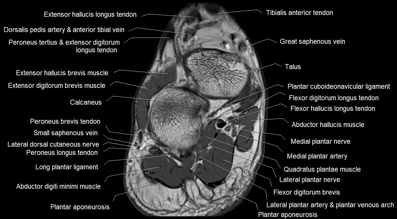 MRI 3T foot axial cross sectional anatomy image 1.webp